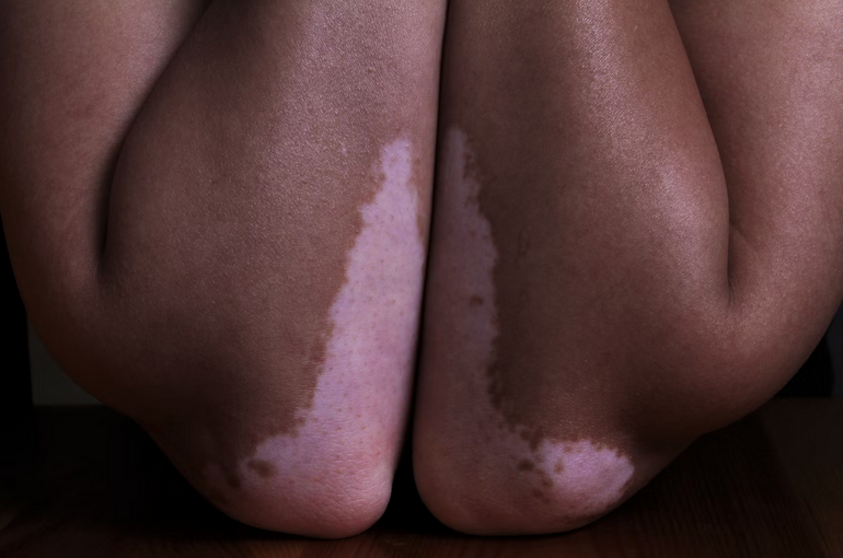 vitiligo